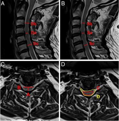 Frontiers Are Surgical Outcomes For One Level Anterior Decompression